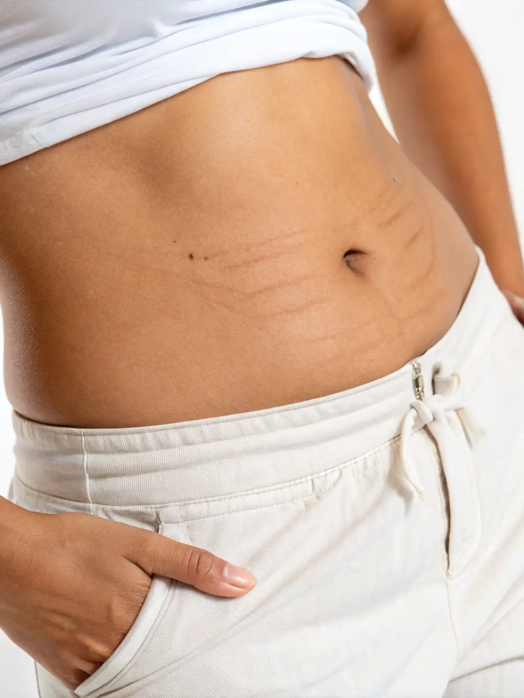 A close-up shot of a client's skin before a stretch mark treatment, showing visible stretch marks.